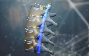 Implantes-de-medula-espinal.